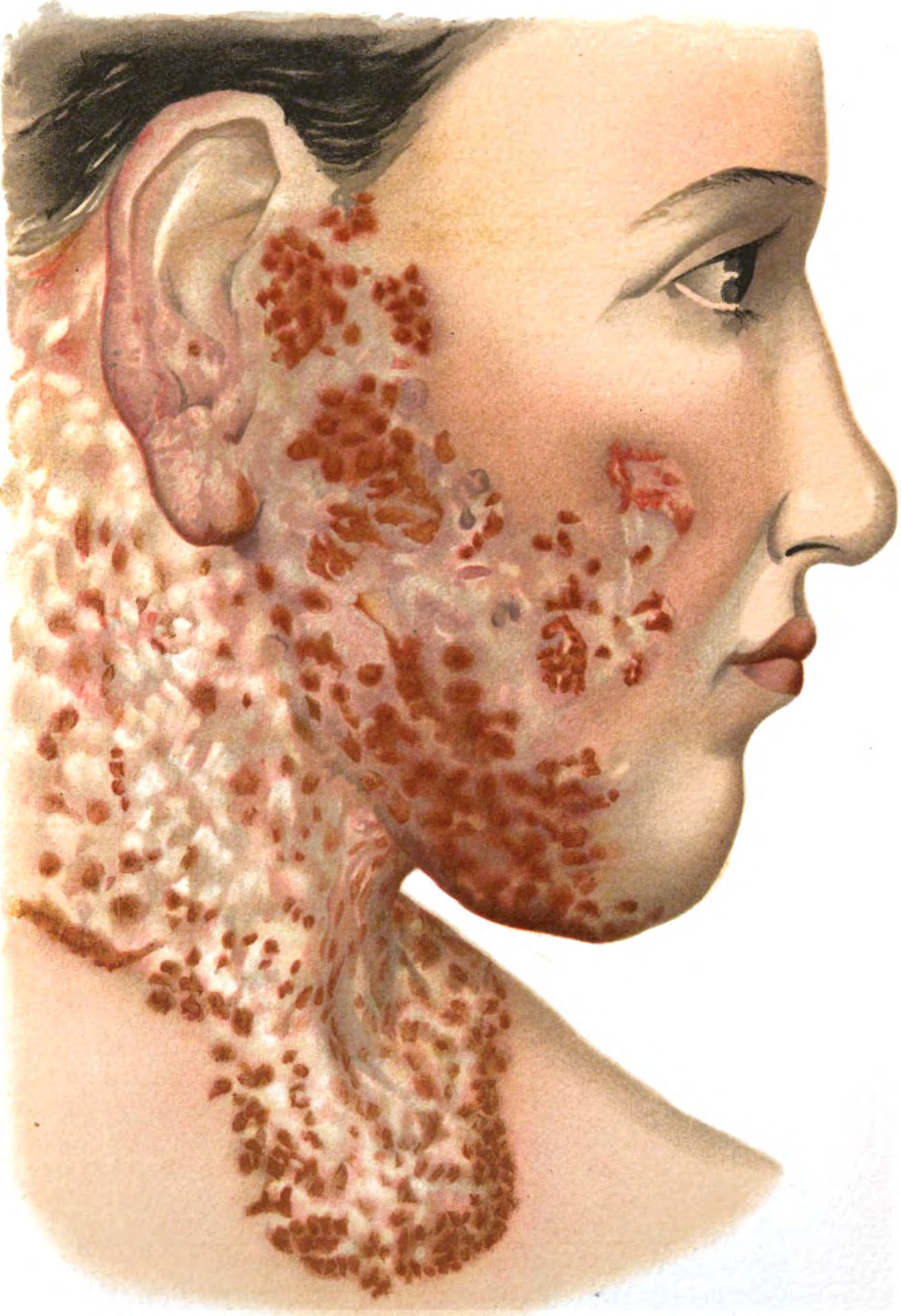 Lupus Vulgaris